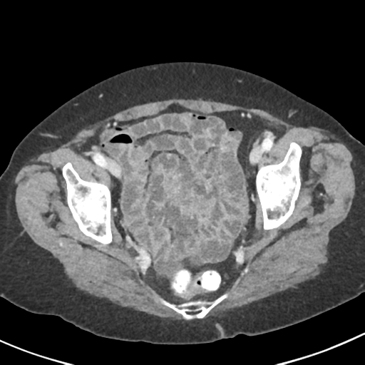 Ampullary adenocarcinoma (Radiopaedia 34013-35237 C 49).png