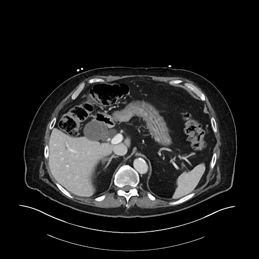 Ampullary adenocarcinoma (Radiopaedia 59373-66734 C 44).jpg