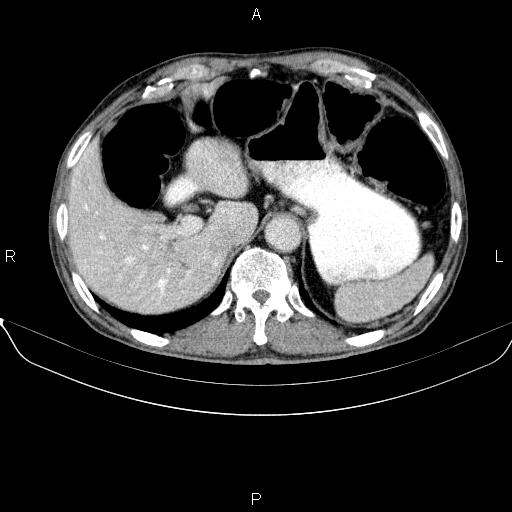File:Ampullary adenocarcinoma (Radiopaedia 86093-102032 A 15).jpg