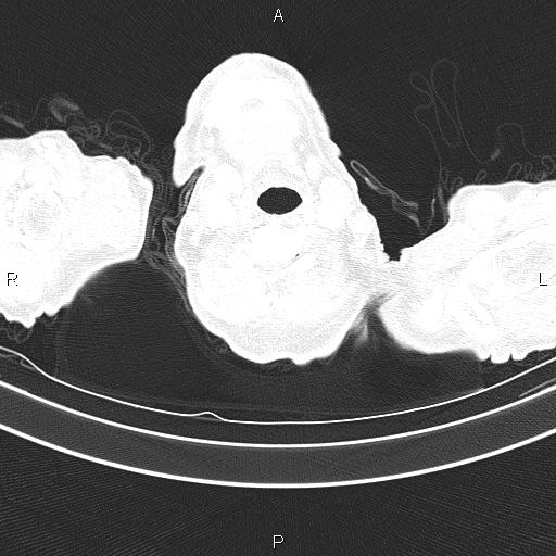 Ampullary adenocarcinoma (Radiopaedia 86093-102033 Axial lung window 3).jpg