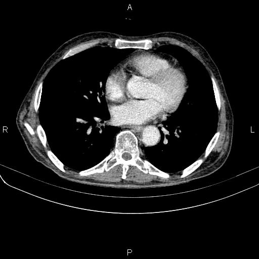 Ampullary adenocarcinoma (Radiopaedia 86093-102033 B 38).jpg