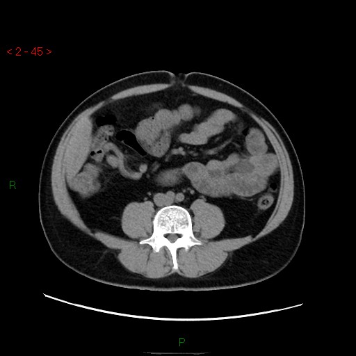 File:Ampullary carcinoma (Radiopaedia 56396-63056 Axial non-contrast 30).jpg