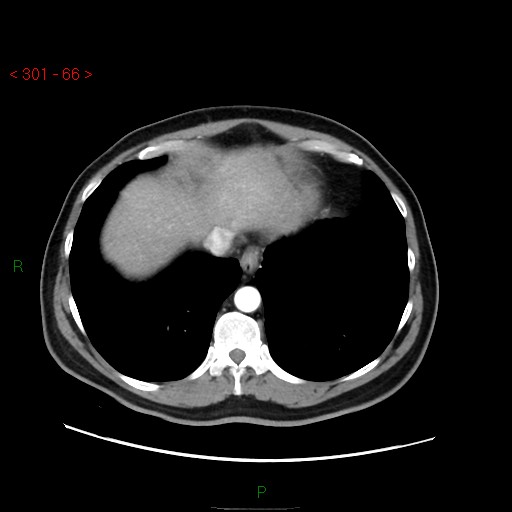 Ampullary carcinoma (Radiopaedia 56396-63056 B 12).jpg