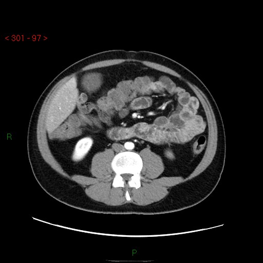 Ampullary carcinoma (Radiopaedia 56396-63056 B 43).jpg