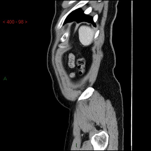 Ampullary carcinoma (Radiopaedia 56396-63056 D 97).jpg