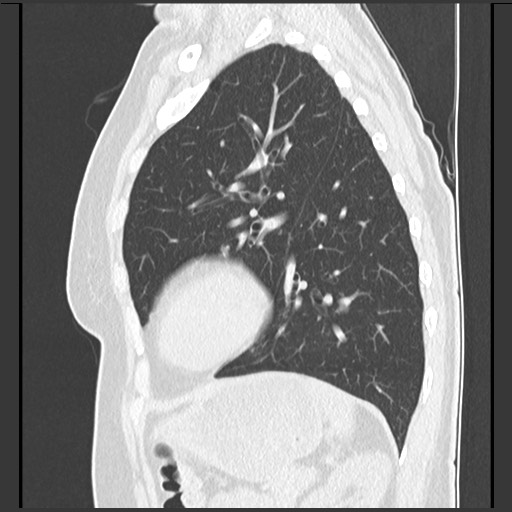 Amyloidosis - bronchial and diffuse nodular pulmonary involvement (Radiopaedia 60156-67744 F 40).jpg