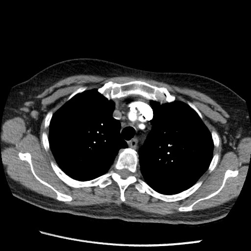 Amyloidosis - bronchial and diffuse nodular pulmonary involvement (Radiopaedia 60156-67745 A 13).jpg