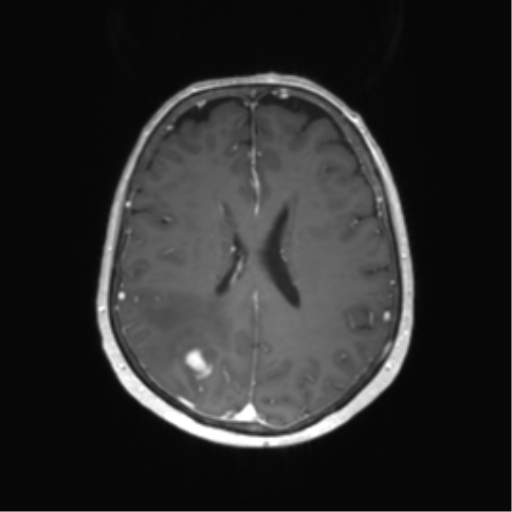 File:Anaplastic astrocytoma (Radiopaedia 86943-103160 Axial T1 C+ 44).png