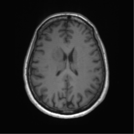 File:Anaplastic astrocytoma - thalamic glioma (Radiopaedia 59709-67115 Axial T1 23).png