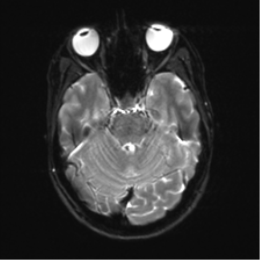 File:Anaplastic astrocytoma IDH mutant (Radiopaedia 50046-55341 Axial DWI 9).png