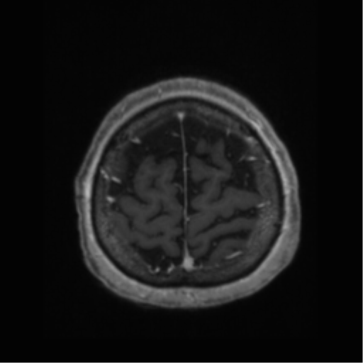 Anaplastic astrocytoma IDH wild-type (pseudoprogression) (Radiopaedia 42209-45277 Axial T1 C+ 112).png