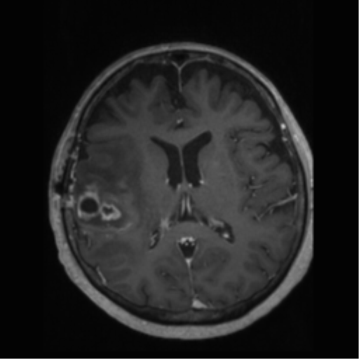 File:Anaplastic astrocytoma IDH wild-type (pseudoprogression) (Radiopaedia 42209-45277 Axial T1 C+ 71).png