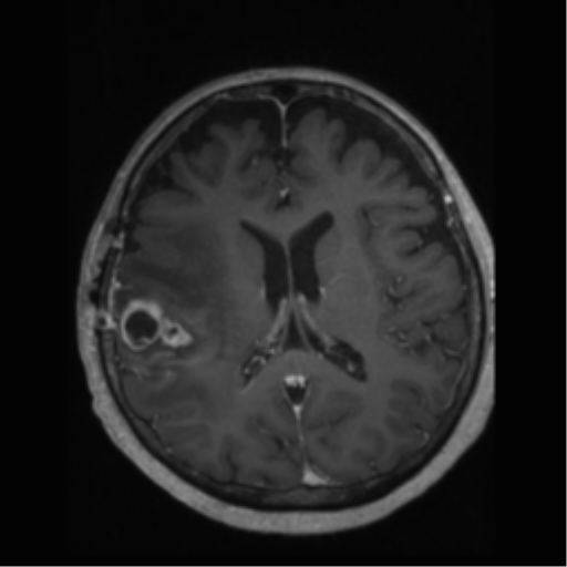 File:Anaplastic astrocytoma IDH wild-type (pseudoprogression) (Radiopaedia 42209-45277 Axial T1 C+ 73).png