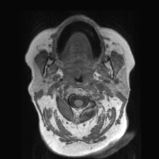 File:Anaplastic astrocytoma IDH wild-type (pseudoprogression) (Radiopaedia 42209-45278 Axial T1 1).png