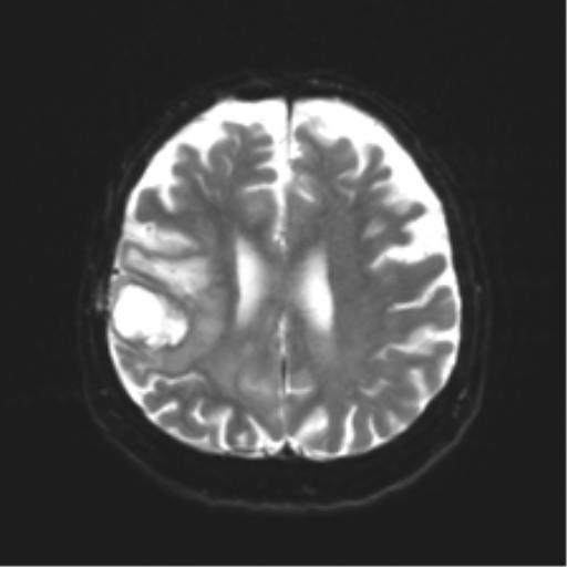 Anaplastic astrocytoma IDH wild-type (pseudoprogression) (Radiopaedia 42209-45279 Axial DWI 18).png