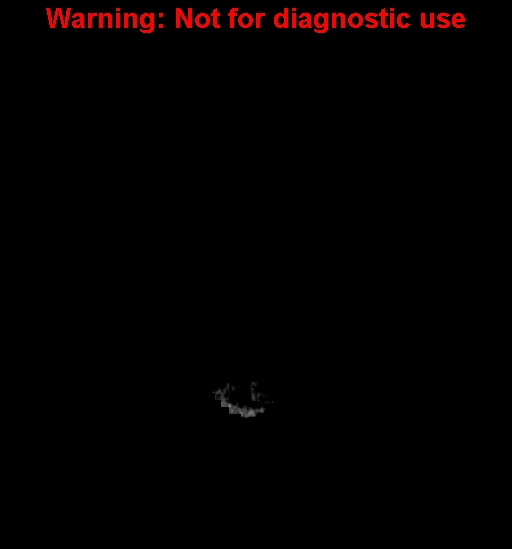 File:Anaplastic ganglioglioma (Radiopaedia 44921-48815 Coronal non-contrast 1).jpg