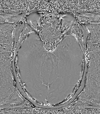 Anaplastic oligodendroglioma (Radiopaedia 83500-98599 Axial SWI - phase 30).png
