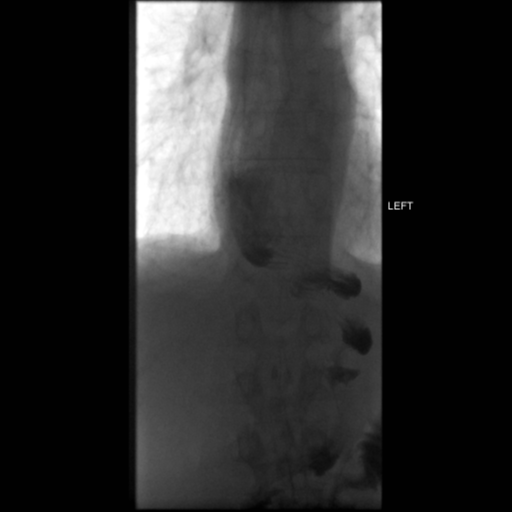 File:Anastomotic stricture post Ivor Lewis esophagectomy (Radiopaedia 47937-52715 C 26).png