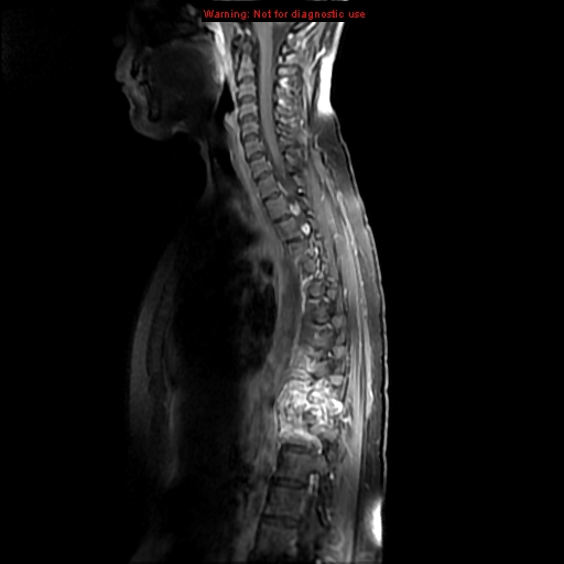 File:Aneurysmal bone cyst (Radiopaedia 9419-10103 Sagittal T1 fat sat 8).jpg