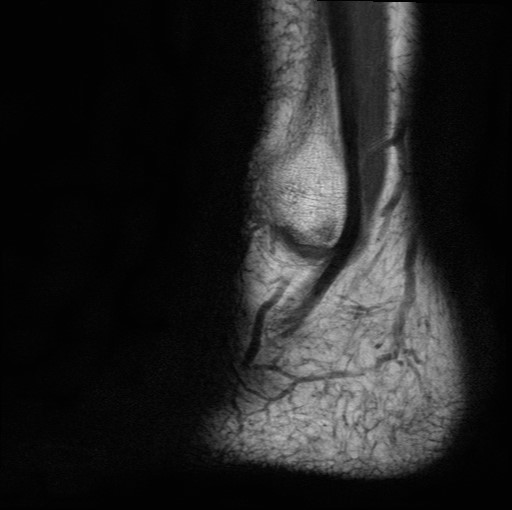 File:Aneurysmal bone cyst of the calcaneus (Radiopaedia 60669-68420 Sagittal T1 1).jpg