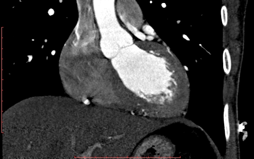 Anomalous left coronary artery from the pulmonary artery (ALCAPA) (Radiopaedia 70148-80181 B 134).jpg