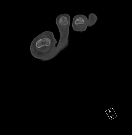 Anterior calcaneal process fracture (Radiopaedia 63353-71943 Axial bone window 27).jpg