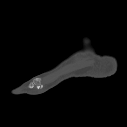 File:Anterior calcaneal process fracture (Radiopaedia 82590-96762 Sagittal bone window 4).jpg