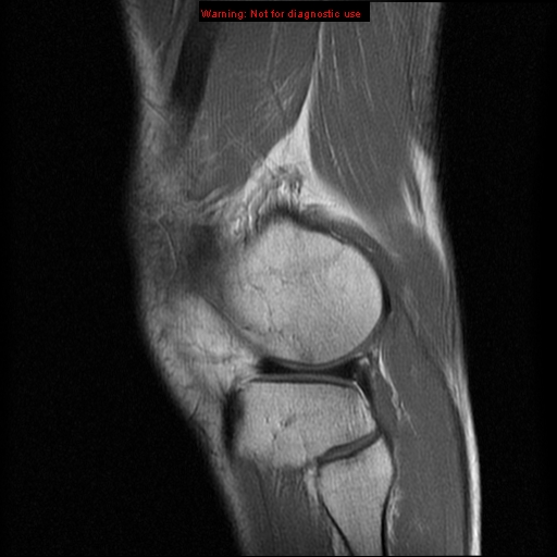 File:Anterior cruciate ligament injury - partial thickness tear (Radiopaedia 12176-12515 Sagittal PD 16).jpg