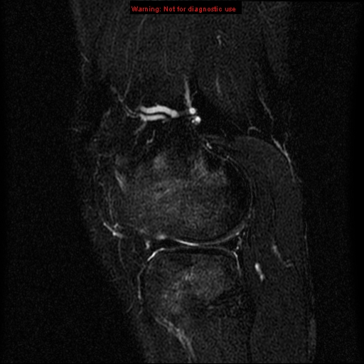File:Anterior cruciate ligament injury - partial thickness tear (Radiopaedia 12176-12515 Sagittal T2 fat sat 15).jpg