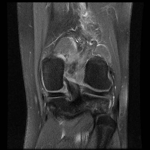 File:Anterior cruciate ligament tear (Radiopaedia 61500-69462 Coronal PD fat sat 15).jpg