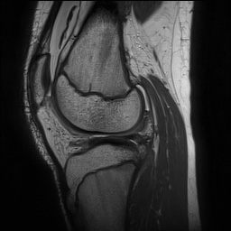 Anterior cruciate ligament tear - pediatric (Radiopaedia 62152-70260 Sagittal PD 111).jpg