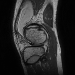 Anterior cruciate ligament tear - pediatric (Radiopaedia 62152-70260 Sagittal PD 137).jpg