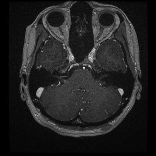 Anterior inferior cerebellar artery vascular loop - type II (Radiopaedia 70991-81209 Axial T1 C+ 48).jpg
