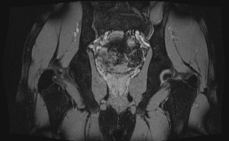 Anterior inferior iliac spine avulsion fracture (Radiopaedia 81312-95000 G 18).jpg