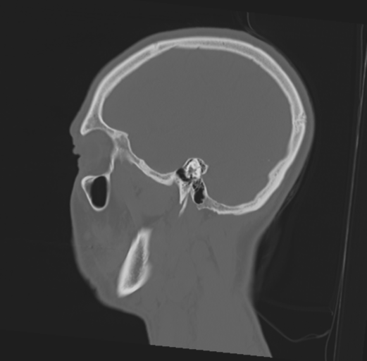 File:Anterior nasal spine fracture (Radiopaedia 46138-50494 Sagittal bone window 16).png