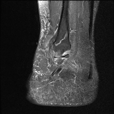 File:Anterior talofibular ligament injury - rupture with soft-tissue impingement (Radiopaedia 38765-40928 Sagittal PD fat sat 17).jpg