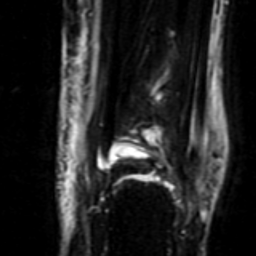 File:Anterior talofibular ligament rupture (Radiopaedia 15831-15484 Coronal STIR 18).jpg
