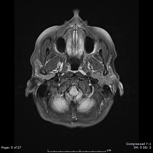 File:Anterior temporal lobe perivascular space (Radiopaedia 88283-104914 Axial FLAIR 5).jpg