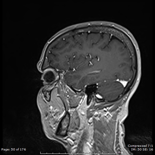 File:Anterior temporal lobe perivascular space (Radiopaedia 88283-104914 Sagittal T1 C+ 11).jpg
