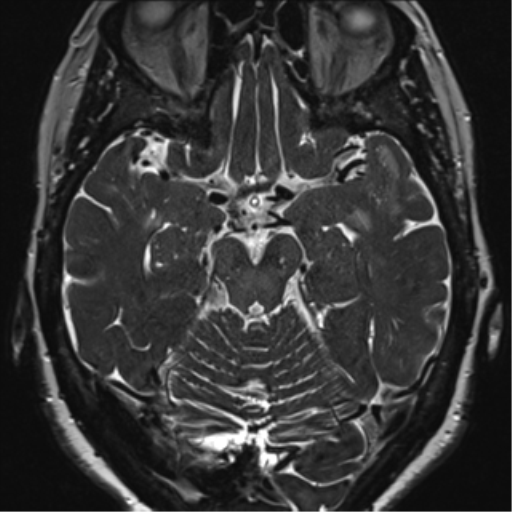 Anterior temporal pole cysts (Radiopaedia 46629-51102 Axial 44).png