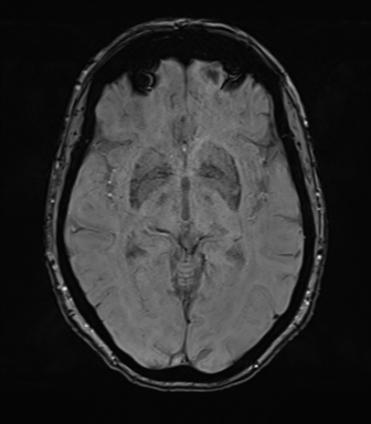 Anterior temporal pole cysts (Radiopaedia 46629-51102 Axial SWI 42).png