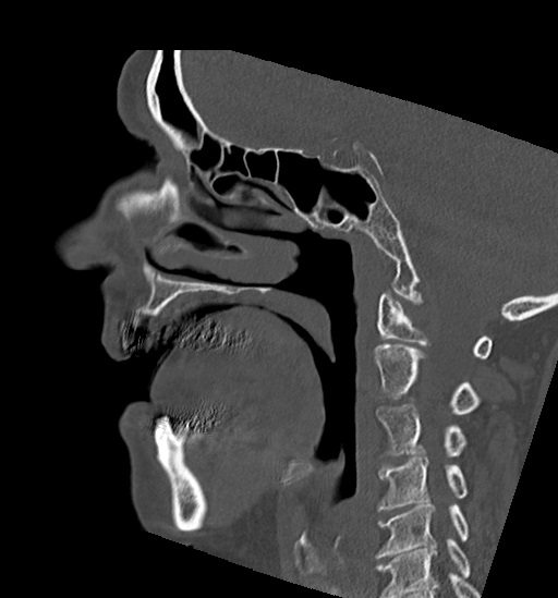 File:Anterior temporomandibular joint dislocation (Radiopaedia 59430-66784 B 36).jpg
