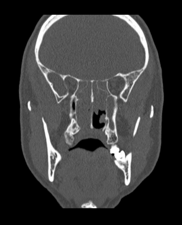 Antrochoanal polyp (Radiopaedia 79011-92169 Coronal bone window 34).jpg