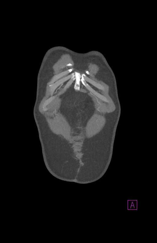 Aortectomy and axillary-bifemoral bypass (Radiopaedia 28303-28545 C 9).jpg
