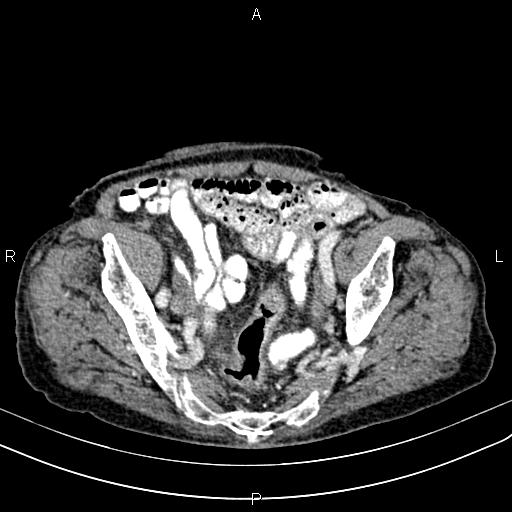 File:Aortic aneurysm and Lemmel syndrome (Radiopaedia 86499-102554 A 66).jpg