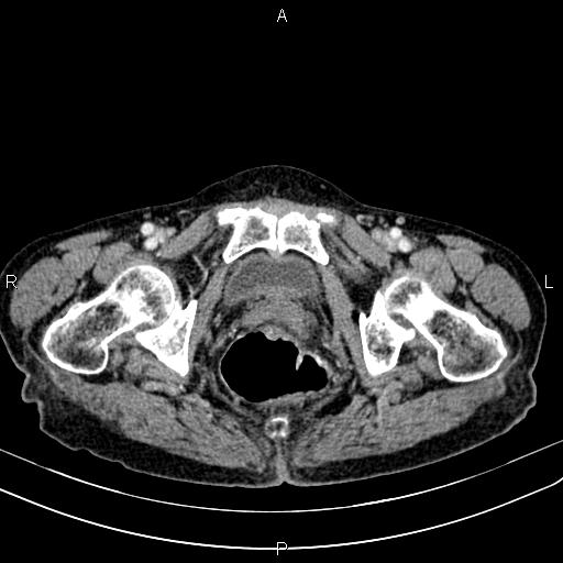 File:Aortic aneurysm and Lemmel syndrome (Radiopaedia 86499-102554 A 80).jpg
