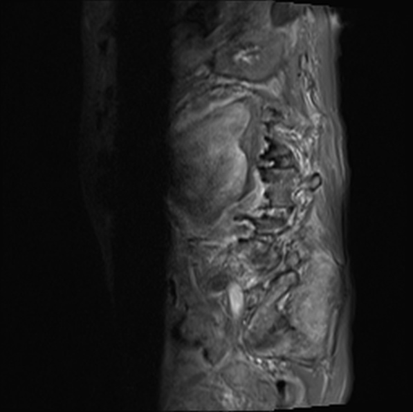 File:Aortic aneurysm with spinal destruction (Radiopaedia 42301-45409 Sagittal T1 fat sat 35).jpg