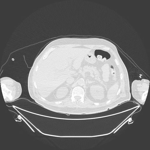 Aortic arch aneurysm (Radiopaedia 84109-99365 Axial lung window 284).jpg