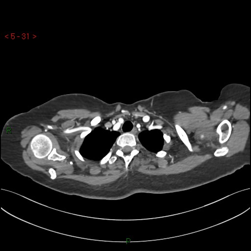 File:Aortic arch origin of left vertebral artery (Radiopaedia 51520-57286 A 30).jpg