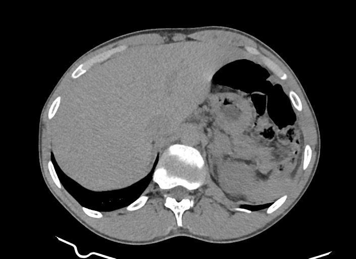 File:Aortic coarctation with aneurysm (Radiopaedia 74818-85828 A 32).jpg
